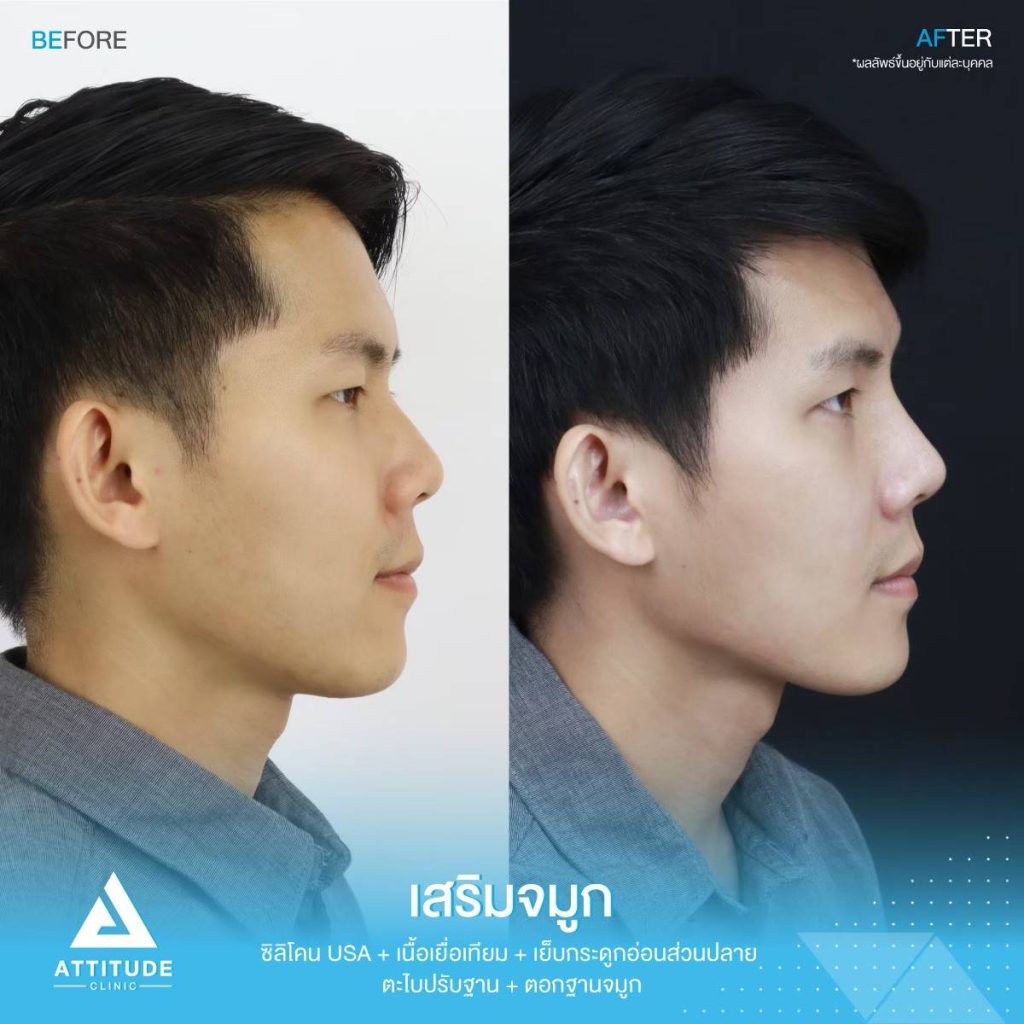 รีวิวเสริมจมูกผู้ชาย ทรงธรรมชาติ ไม่โป๊ะ ฝีมือหมอยุ้ย Attitude Clinic รัชดา