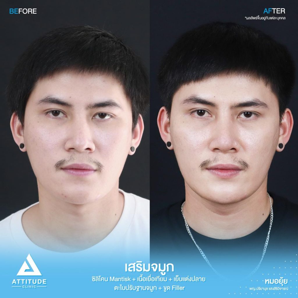รีวิวเสริมจมูกผู้ชาย ทรงธรรมชาติ ไม่โป๊ะ ฝีมือหมอยุ้ย Attitude Clinic รัชดา