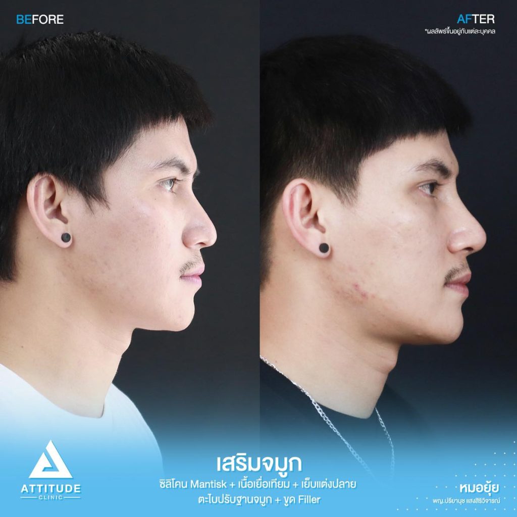 รีวิวเสริมจมูกผู้ชาย ทรงธรรมชาติ ไม่โป๊ะ ฝีมือหมอยุ้ย Attitude Clinic รัชดา