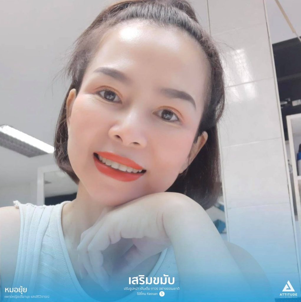 รูปรีวิวเสริมขมับด้วยซิลิโคน