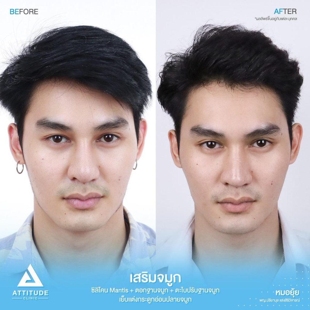 รีวิวเสริมจมูกผู้ชาย ทรงธรรมชาติ ไม่โป๊ะ ฝีมือหมอยุ้ย Attitude Clinic รัชดา