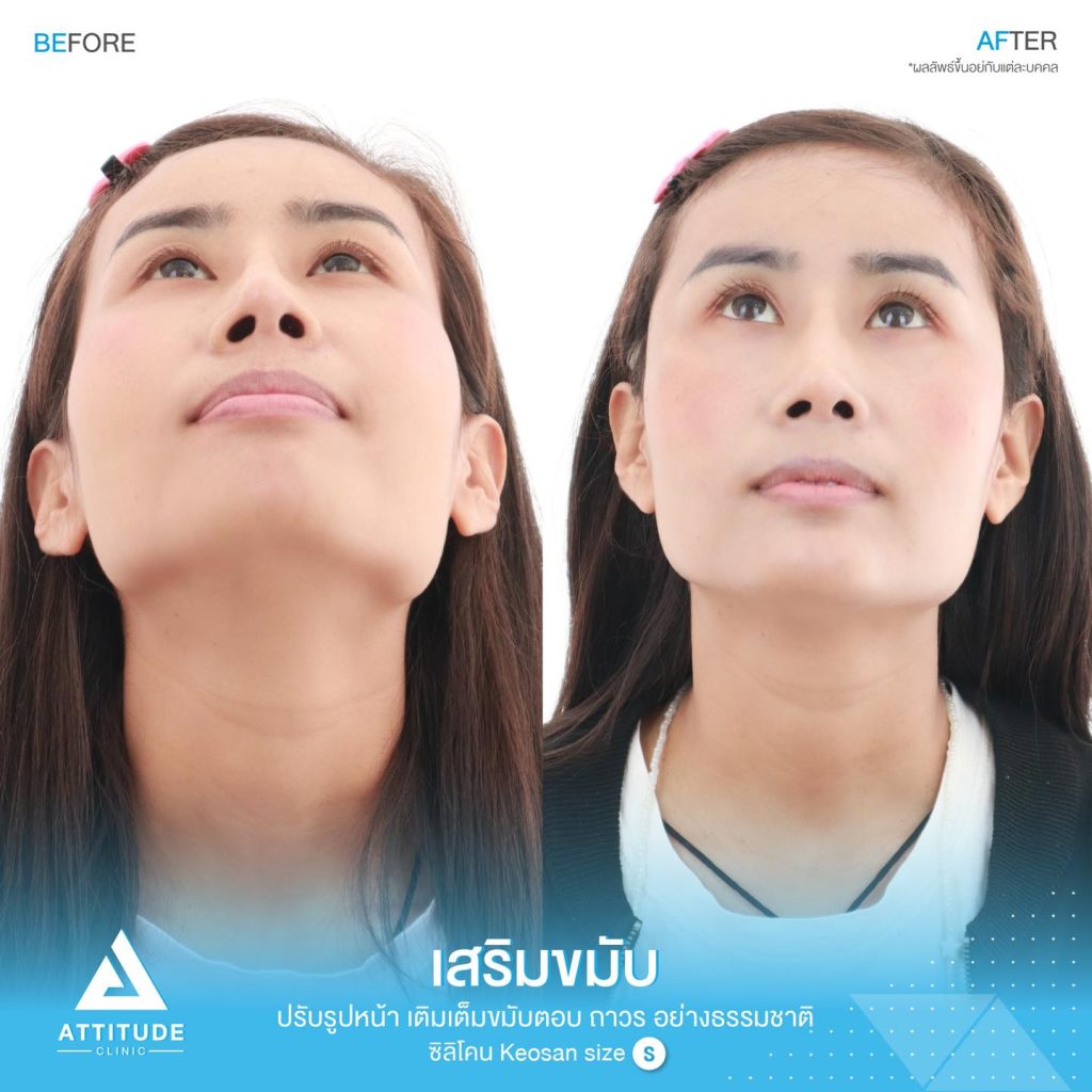 รูปรีวิวเสริมขมับด้วยซิลิโคน