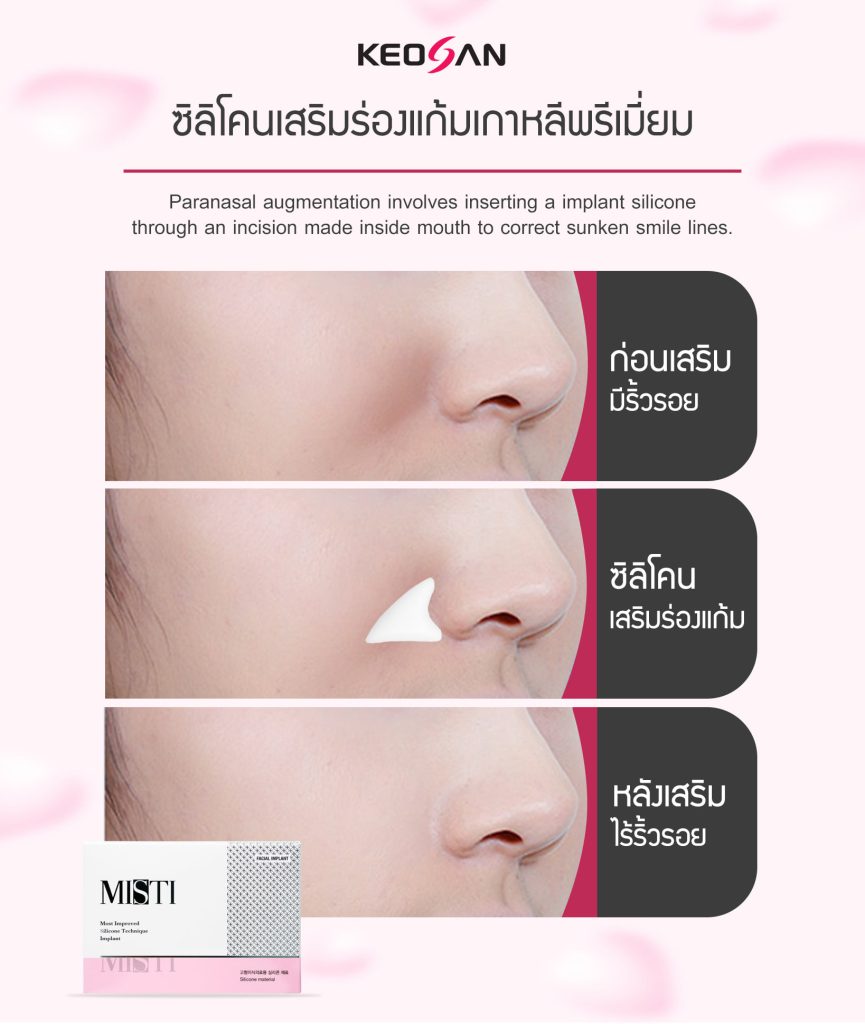 ซิลิโคนเสริมร่องแก้ม