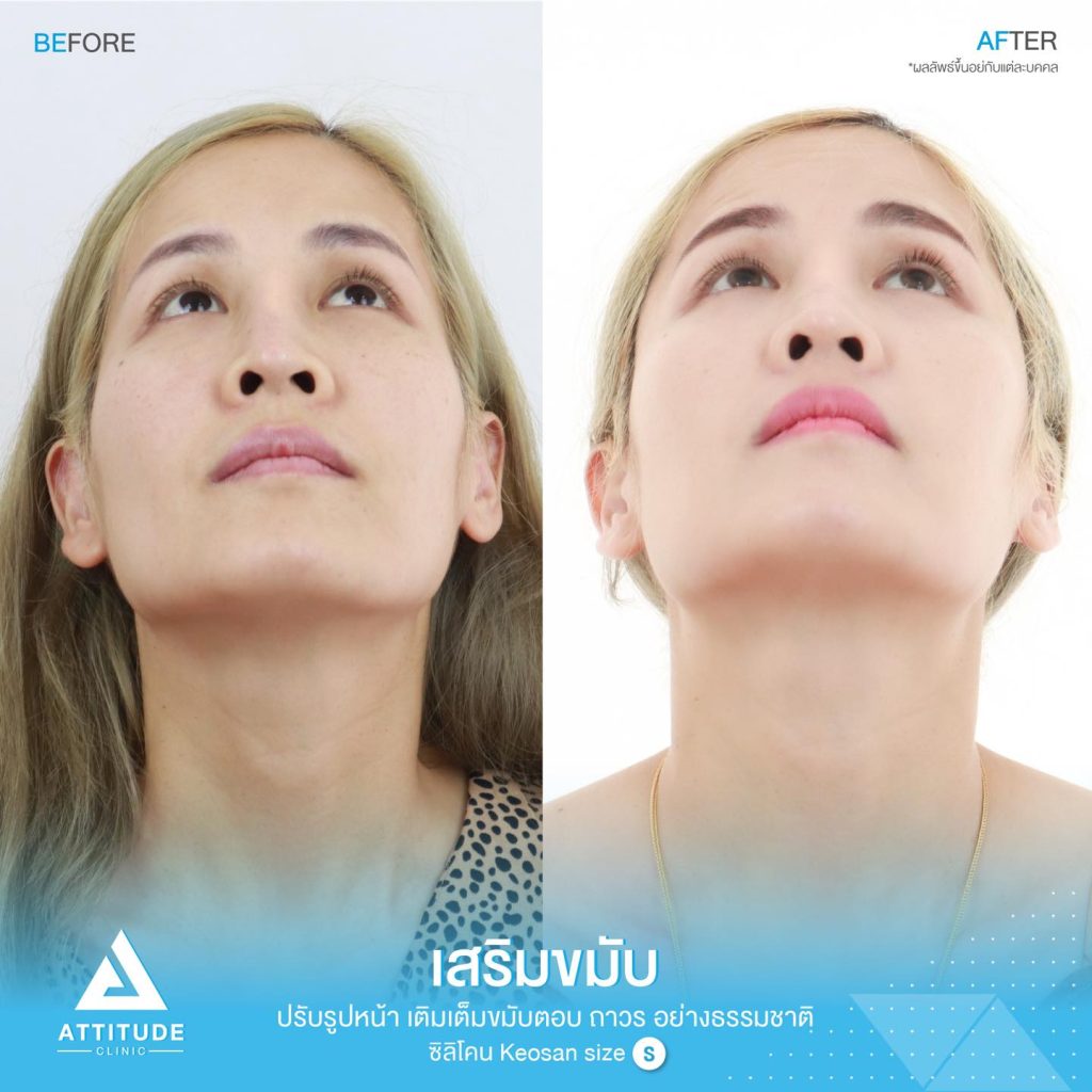 รูปรีวิวเสริมขมับด้วยซิลิโคน
