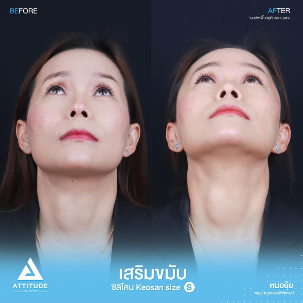 รูปรีวิวเสริมขมับด้วยซิลิโคน