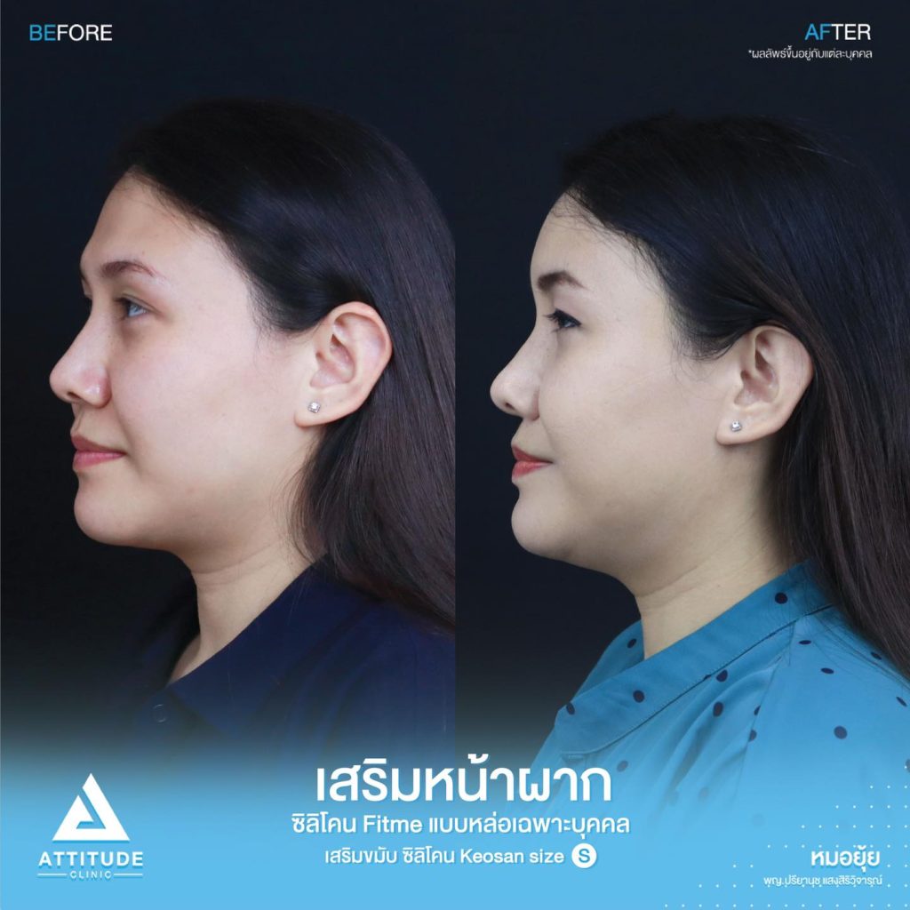 รีวิวเสริมหน้าผาก