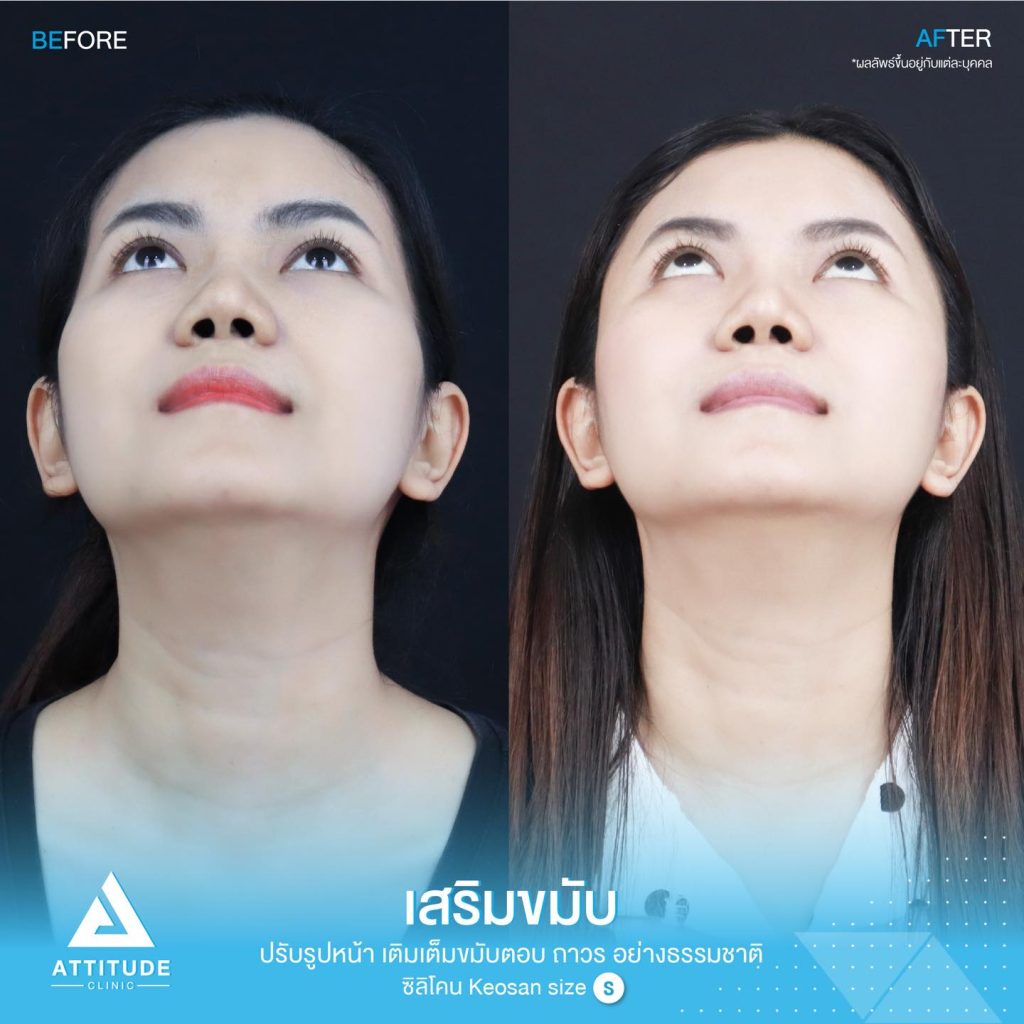 รูปรีวิวเสริมขมับด้วยซิลิโคน