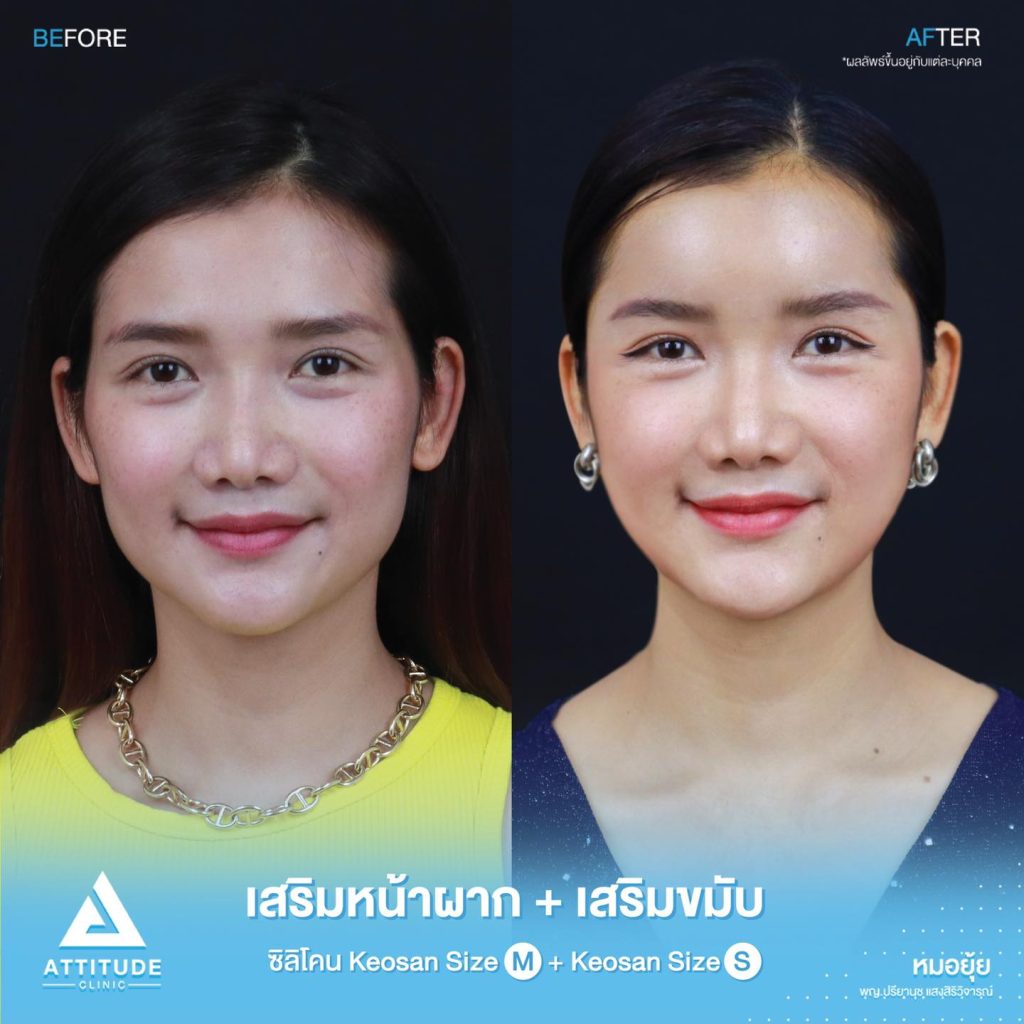 รูปรีวิวเสริมขมับด้วยซิลิโคน
