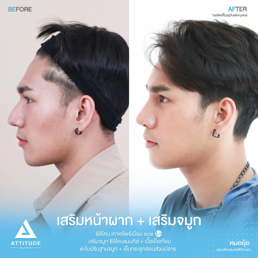 รีวิวเสริมจมูกผู้ชาย ทรงธรรมชาติ ไม่โป๊ะ ฝีมือหมอยุ้ย Attitude Clinic รัชดา