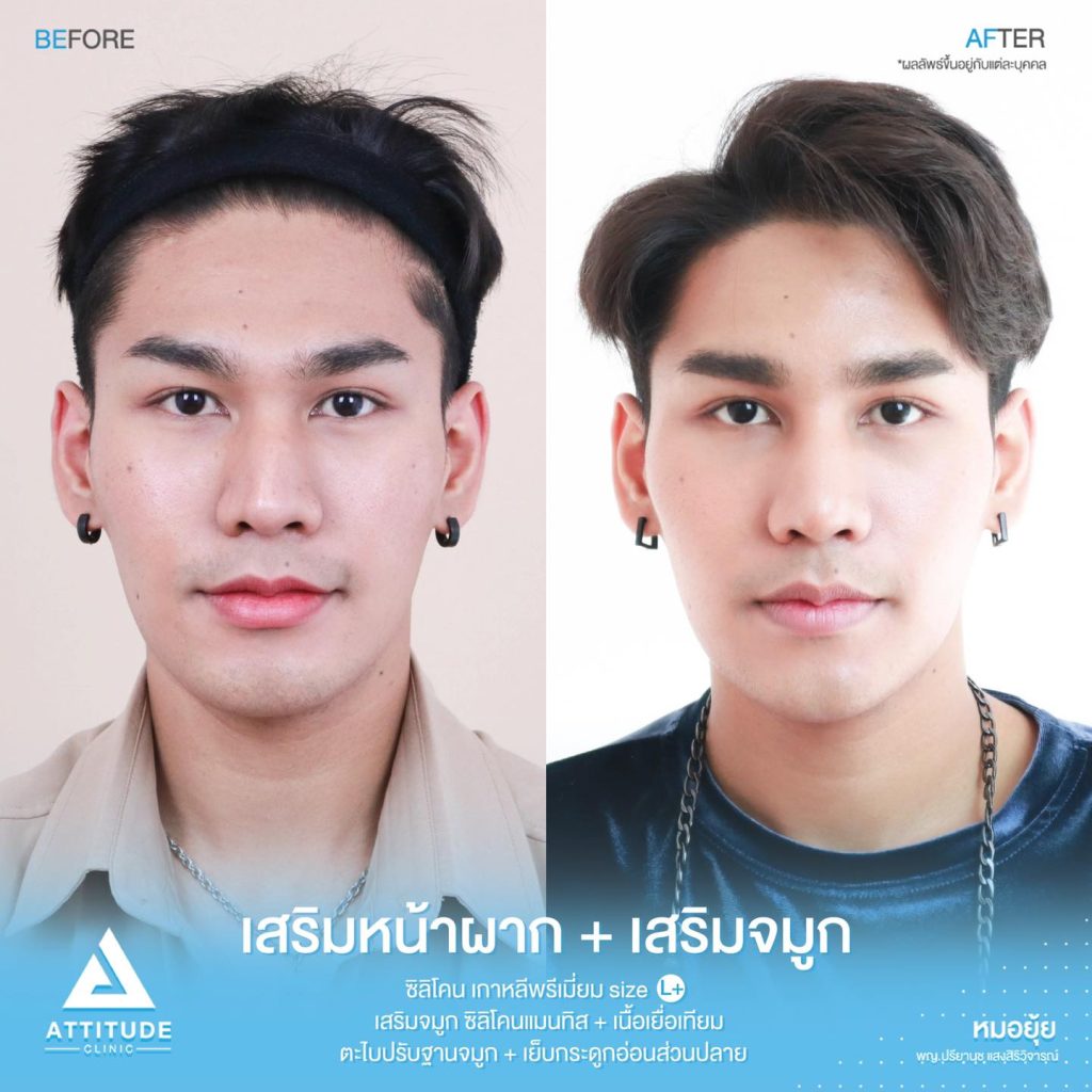 รีวิวเสริมจมูกผู้ชาย ทรงธรรมชาติ ไม่โป๊ะ ฝีมือหมอยุ้ย Attitude Clinic รัชดา