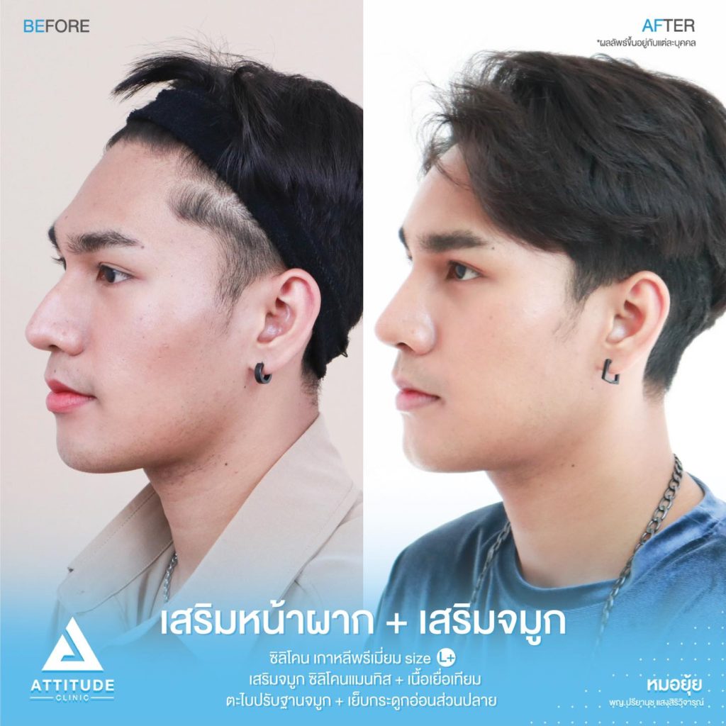 รีวิวเสริมหน้าผาก