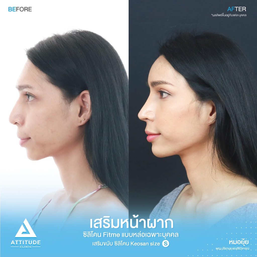รีวิวเสริมหน้าผาก