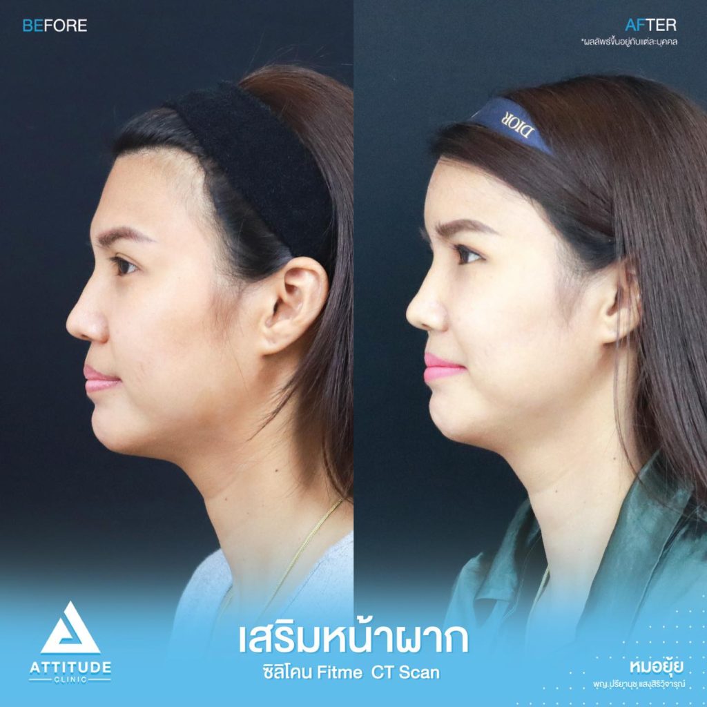 รีวิวเสริมหน้าผาก