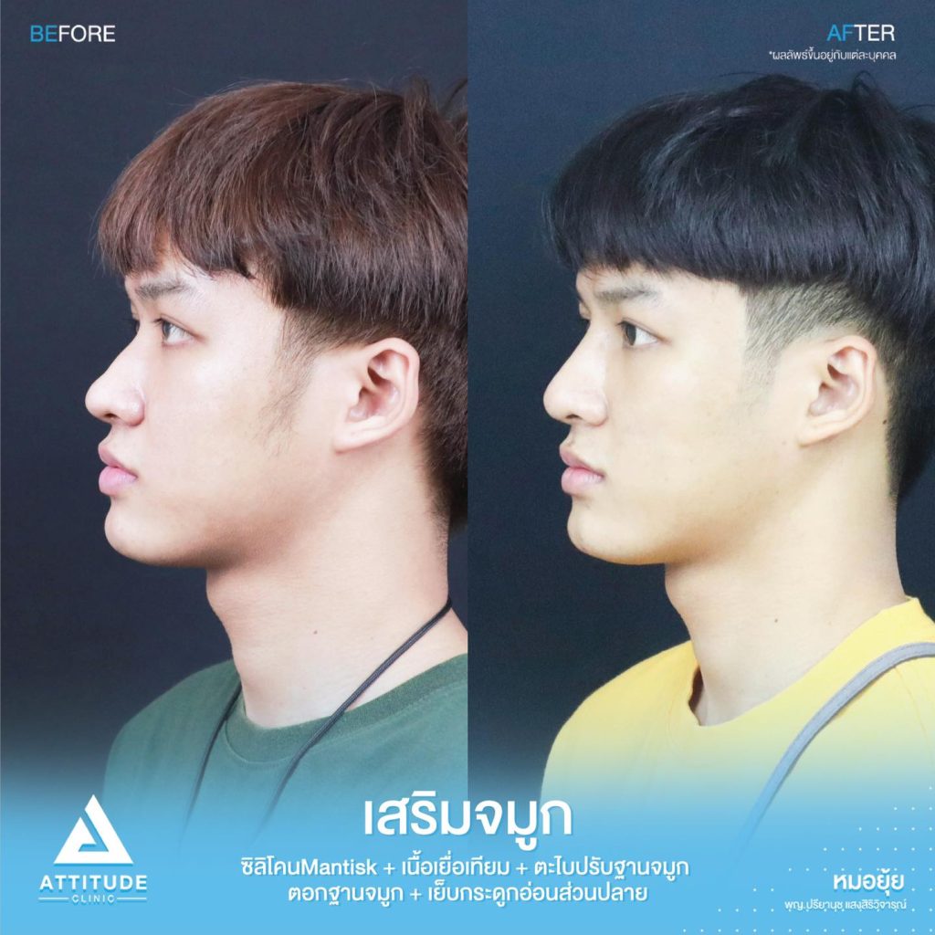 รีวิวเสริมจมูกผู้ชาย ทรงธรรมชาติ ไม่โป๊ะ ฝีมือหมอยุ้ย Attitude Clinic รัชดา