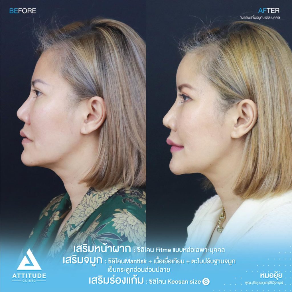 รีวิวเสริมหน้าผากด้วยซิลิโคน
