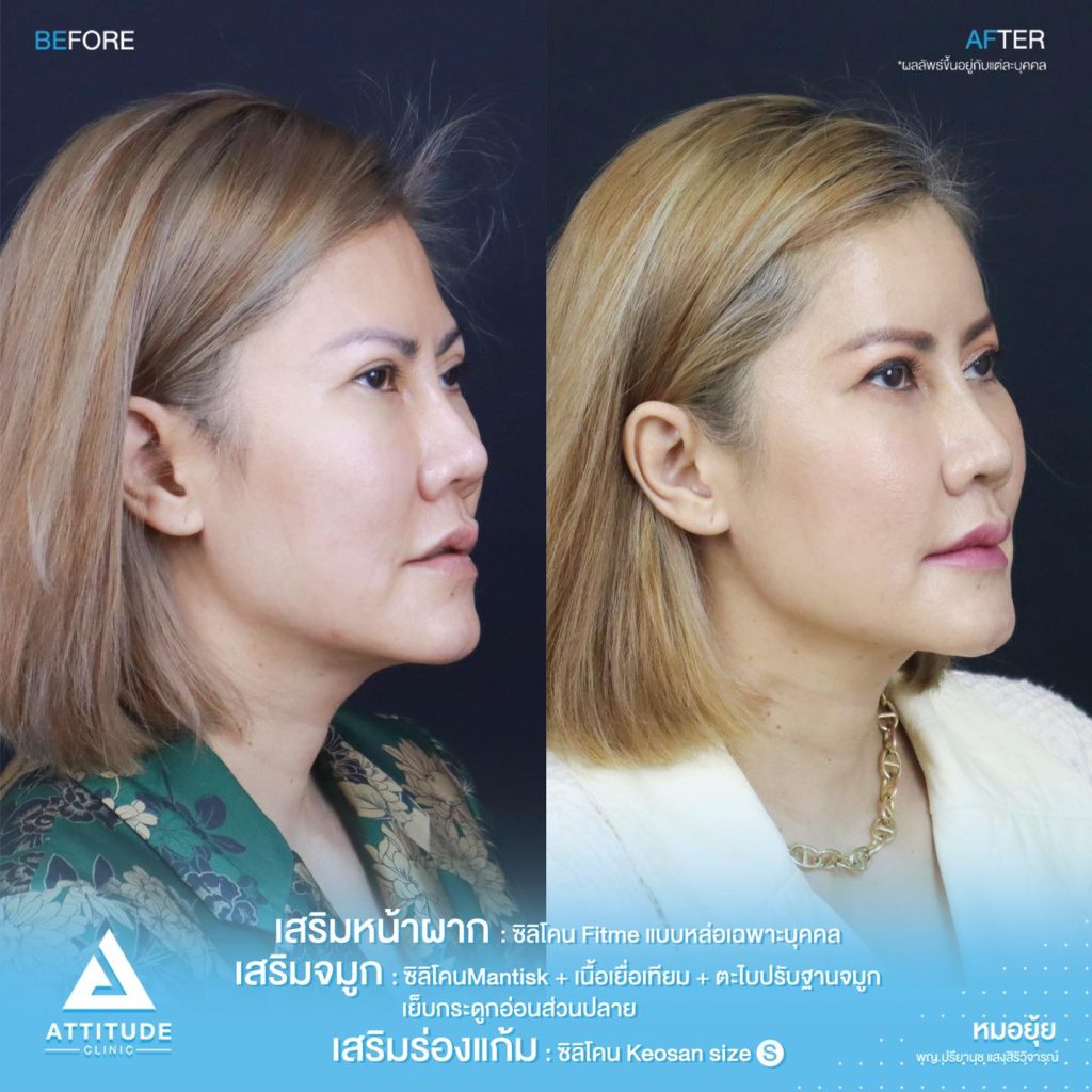 รีวิวเสริมร่องแก้มด้วยซิลิโคน