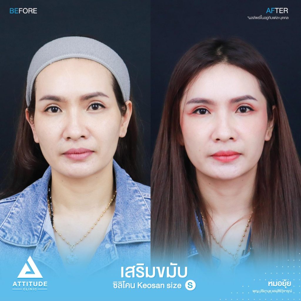 รูปรีวิวเสริมขมับด้วยซิลิโคน
