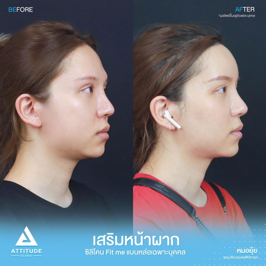 รีวิวเสริมหน้าผากด้วยซิลิโคน