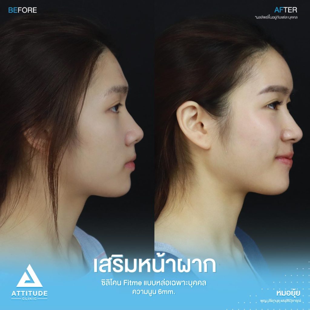 รีวิวเสริมหน้าผาก