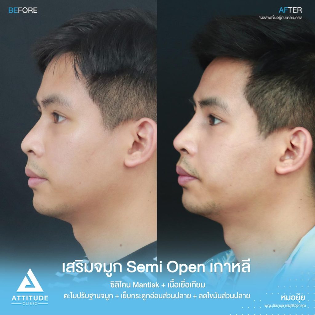 รีวิวเสริมจมูกผู้ชาย ทรงธรรมชาติ ไม่โป๊ะ ฝีมือหมอยุ้ย Attitude Clinic รัชดา