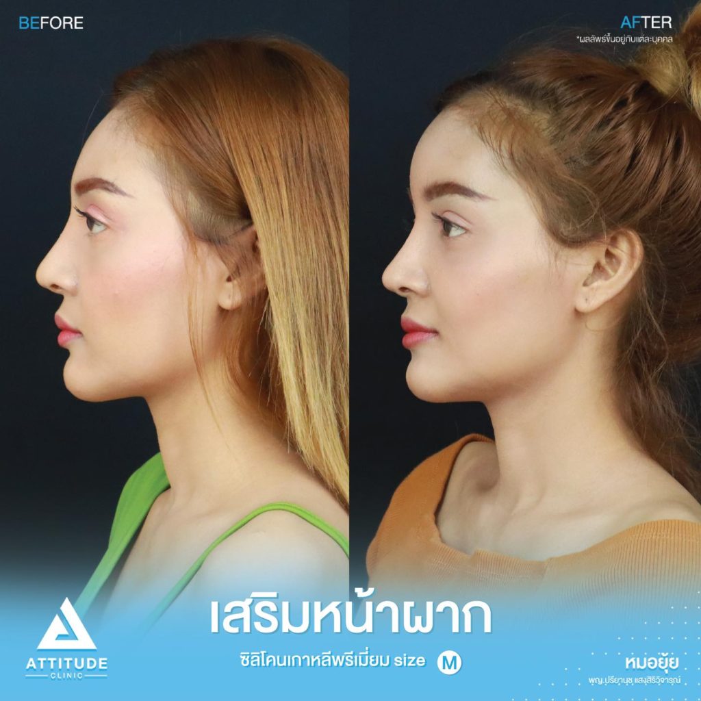 รีวิวเสริมหน้าผากด้วยซิลิโคน