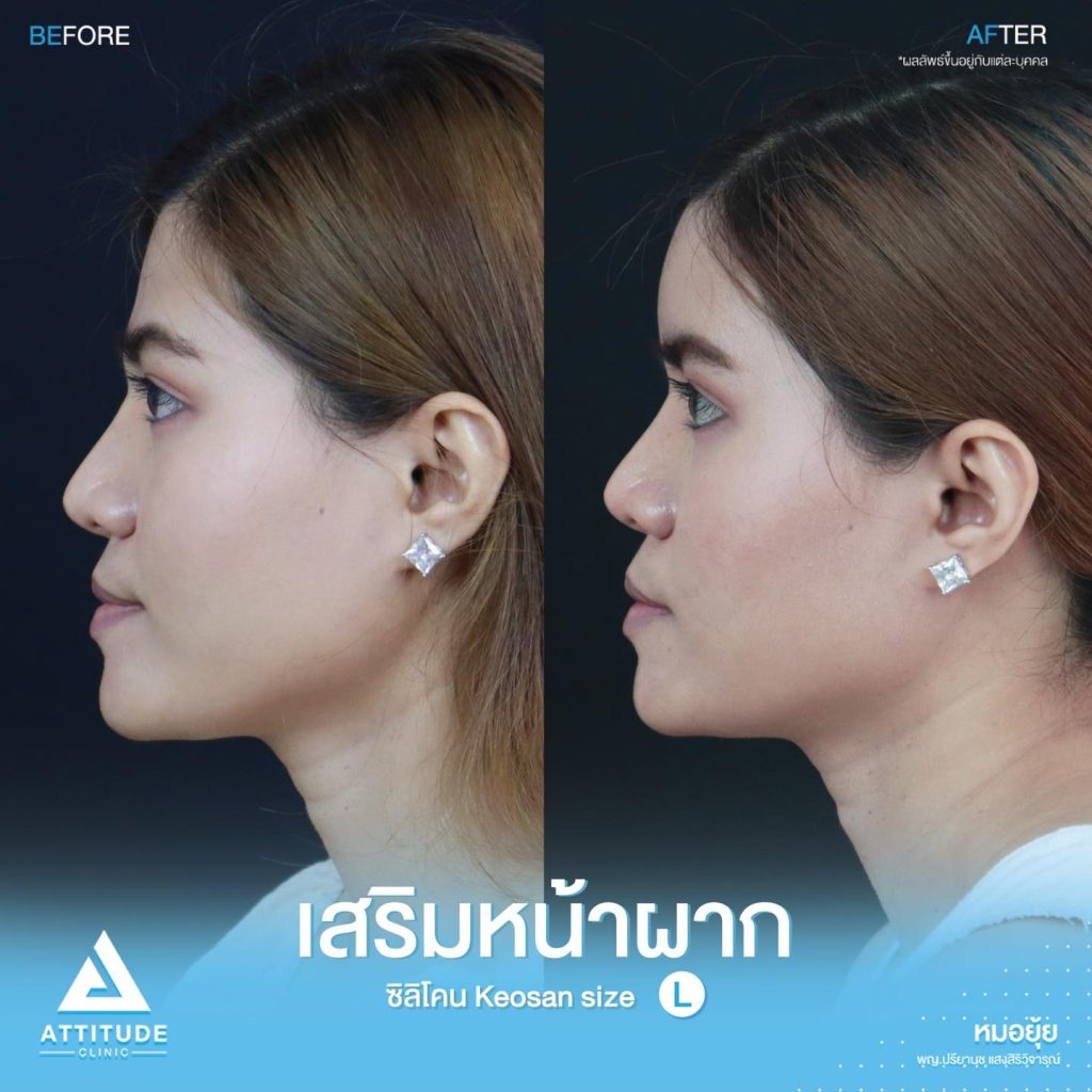 รีวิวเสริมหน้าผากด้วยซิลิโคน