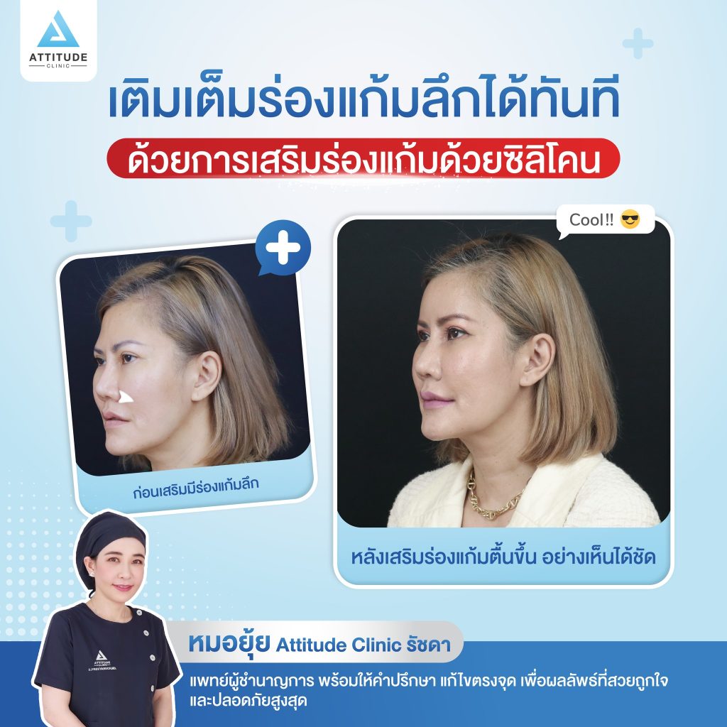 เสริมร่องแก้มด้วยซิลิโคนแบบถาวร