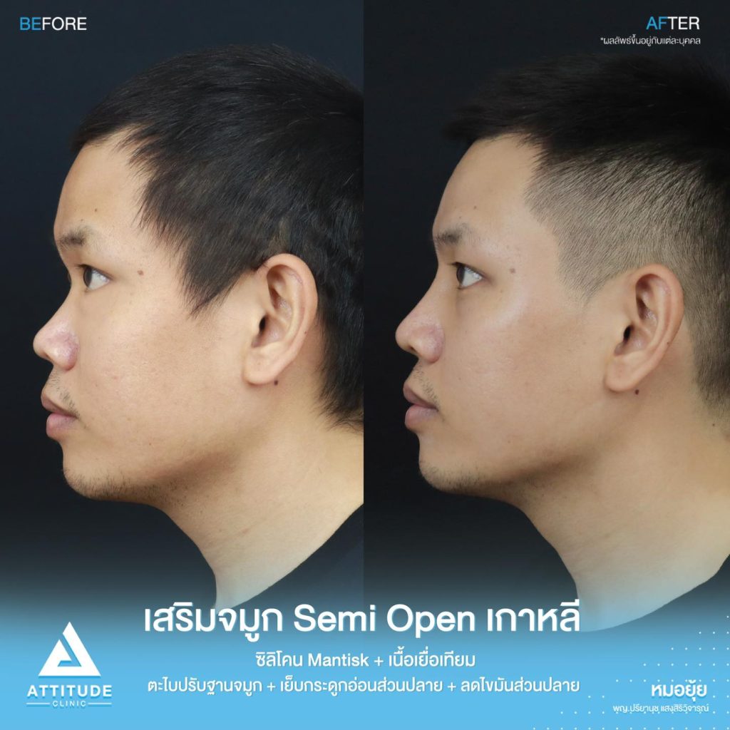 รีวิวเสริมจมูกผู้ชาย ทรงธรรมชาติ ไม่โป๊ะ ฝีมือหมอยุ้ย Attitude Clinic รัชดา