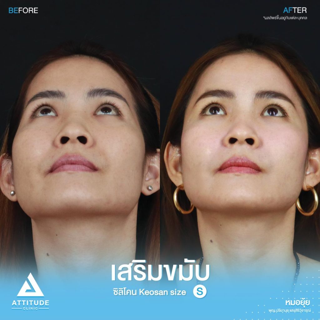 รูปรีวิวเสริมขมับด้วยซิลิโคน