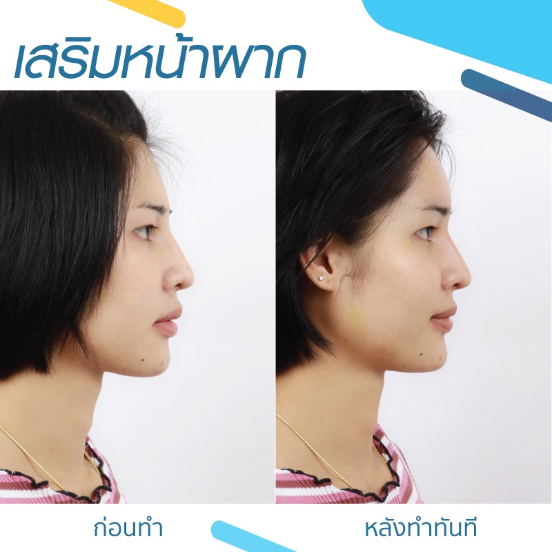 รีวิวเสริมหน้าผากด้วยซิลิโคน