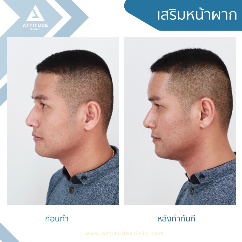 รีวิวเสริมหน้าผาก