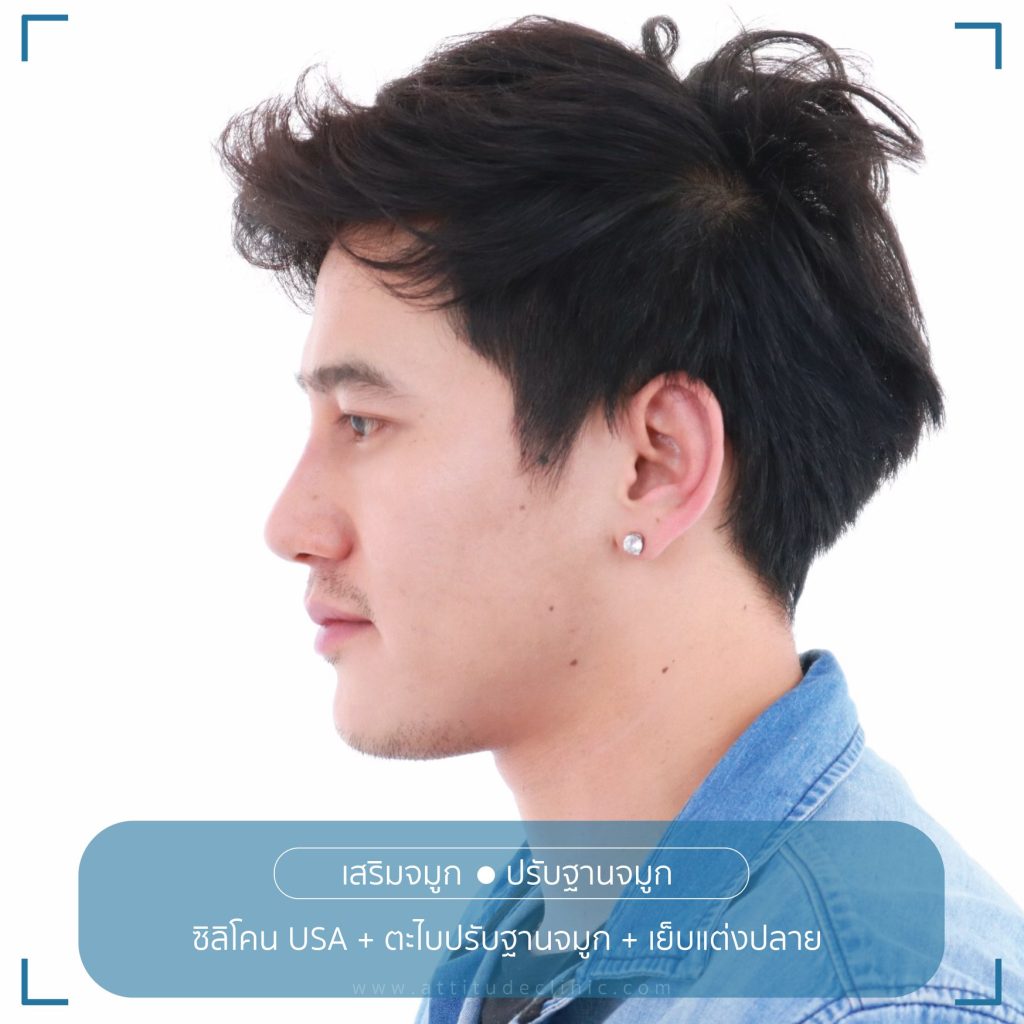 รีวิวเสริมจมูกผู้ชาย ทรงธรรมชาติ ไม่โป๊ะ ฝีมือหมอยุ้ย Attitude Clinic รัชดา