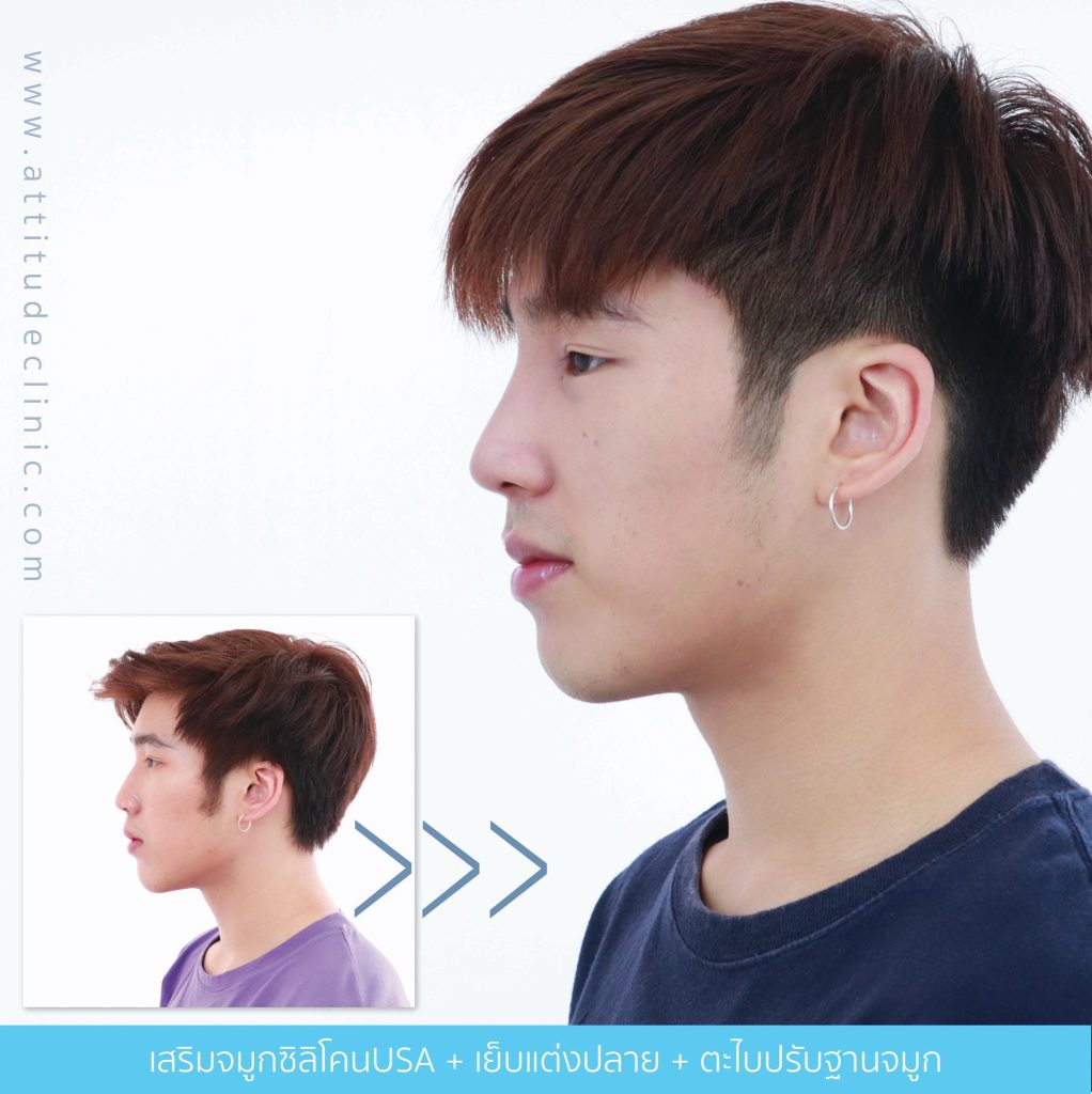 รีวิวเสริมจมูกผู้ชาย ทรงธรรมชาติ ไม่โป๊ะ ฝีมือหมอยุ้ย Attitude Clinic รัชดา