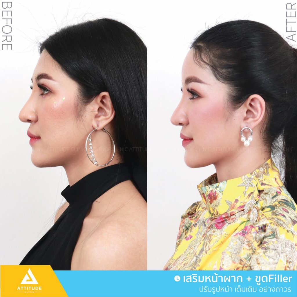 รีวิวเสริมหน้าผาก