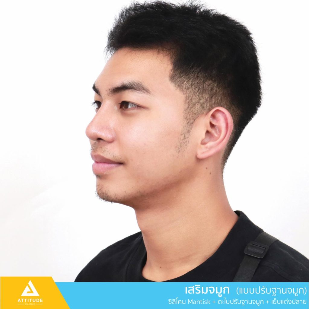 รีวิวเสริมจมูกผู้ชาย ทรงธรรมชาติ ไม่โป๊ะ ฝีมือหมอยุ้ย Attitude Clinic รัชดา