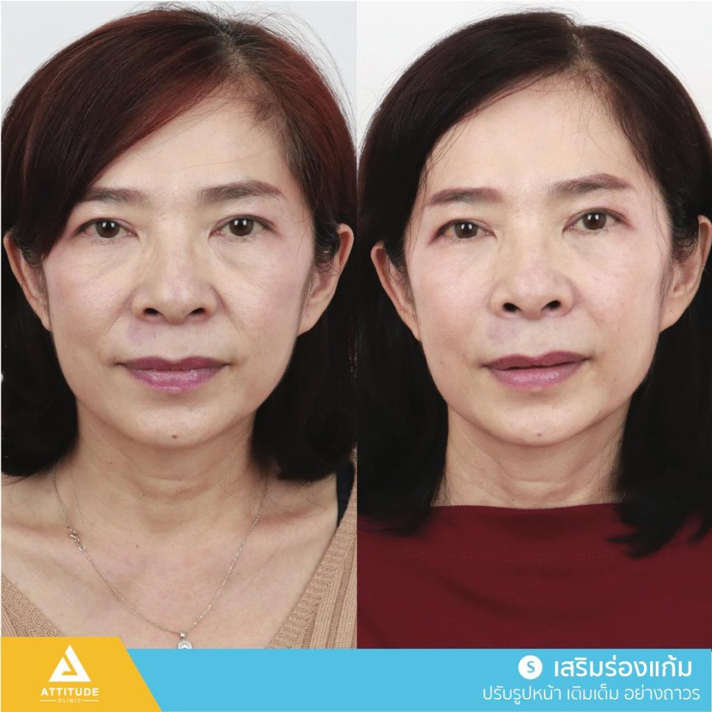 รีวิวเสริมร่องแก้มด้วยซิลิโคน