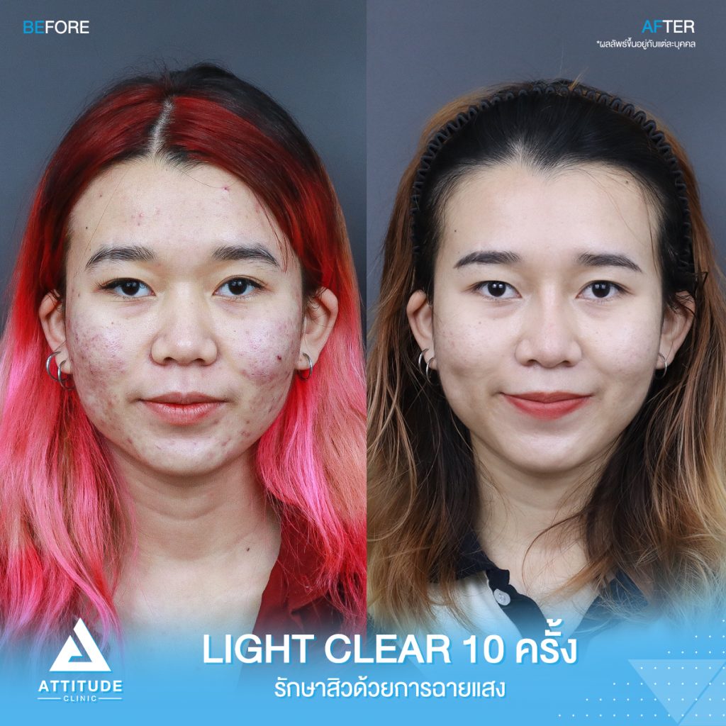 รีวิวรักษาสิวครบวงจร รีวิวรักษาสิวครบวงจร โปรแกรม Light Clear 7 ขั้นตอน จำนวน 10 ครั้ง ของน้องคะนิ้ง มีปัญหาสิวและรอยสิวจัดเต็ม หลังรักษาสิวตอนนี้หน้าใสวิ้ง ผิวเรียบเนียน มั่นใจขึ้นสุดๆ