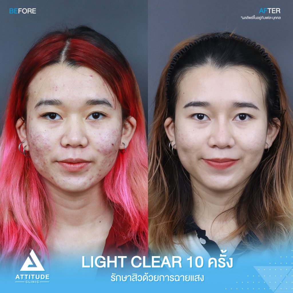 รีวิวรักษาสิวครบวงจร โปรแกรม Light Clear 7 ขั้นตอน จำนวน 10 ครั้ง ของน้องคะนิ้ง มีปัญหาสิวและรอยสิวจัดเต็ม หลังรักษาสิวตอนนี้หน้าใสวิ้ง ผิวเรียบเนียน มั่นใจขึ้นสุดๆ