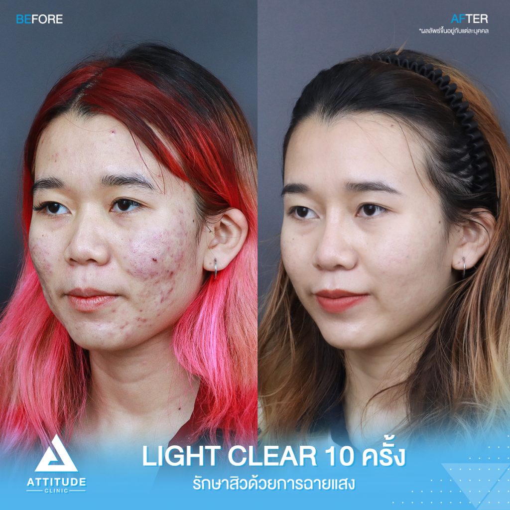 รีวิวรักษาสิวครบวงจร โปรแกรม Light Clear 7 ขั้นตอน จำนวน 10 ครั้ง ของน้องคะนิ้ง มีปัญหาสิวและรอยสิวจัดเต็ม หลังรักษาสิวตอนนี้หน้าใสวิ้ง ผิวเรียบเนียน มั่นใจขึ้นสุดๆ