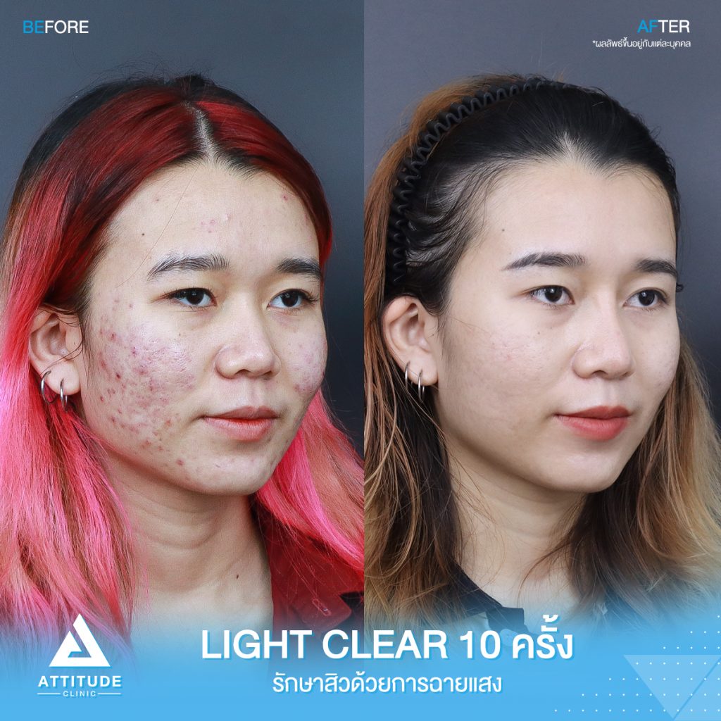 รีวิวรักษาสิวครบวงจร โปรแกรม Light Clear 7 ขั้นตอน จำนวน 10 ครั้ง ของน้องคะนิ้ง มีปัญหาสิวและรอยสิวจัดเต็ม หลังรักษาสิวตอนนี้หน้าใสวิ้ง ผิวเรียบเนียน มั่นใจขึ้นสุดๆ