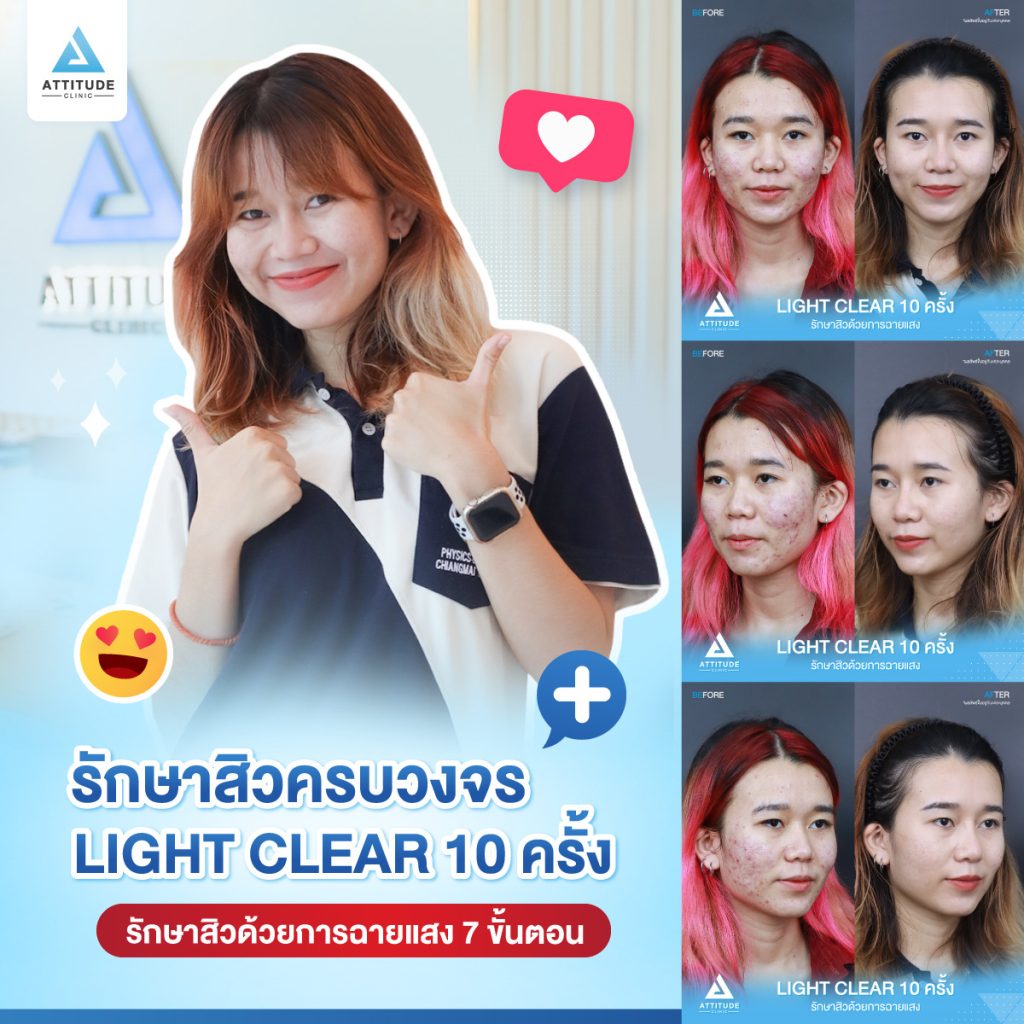 รีวิวรักษาสิวครบวงจร โปรแกรม Light Clear 7 ขั้นตอน จำนวน 10 ครั้ง ของน้องคะนิ้ง มีปัญหาสิวและรอยสิวจัดเต็ม หลังรักษาสิวตอนนี้หน้าใสวิ้ง ผิวเรียบเนียน มั่นใจขึ้นสุดๆ