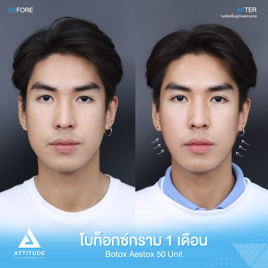 ฉีดโบท็อกซ์ กี่วันเห็นผล ?