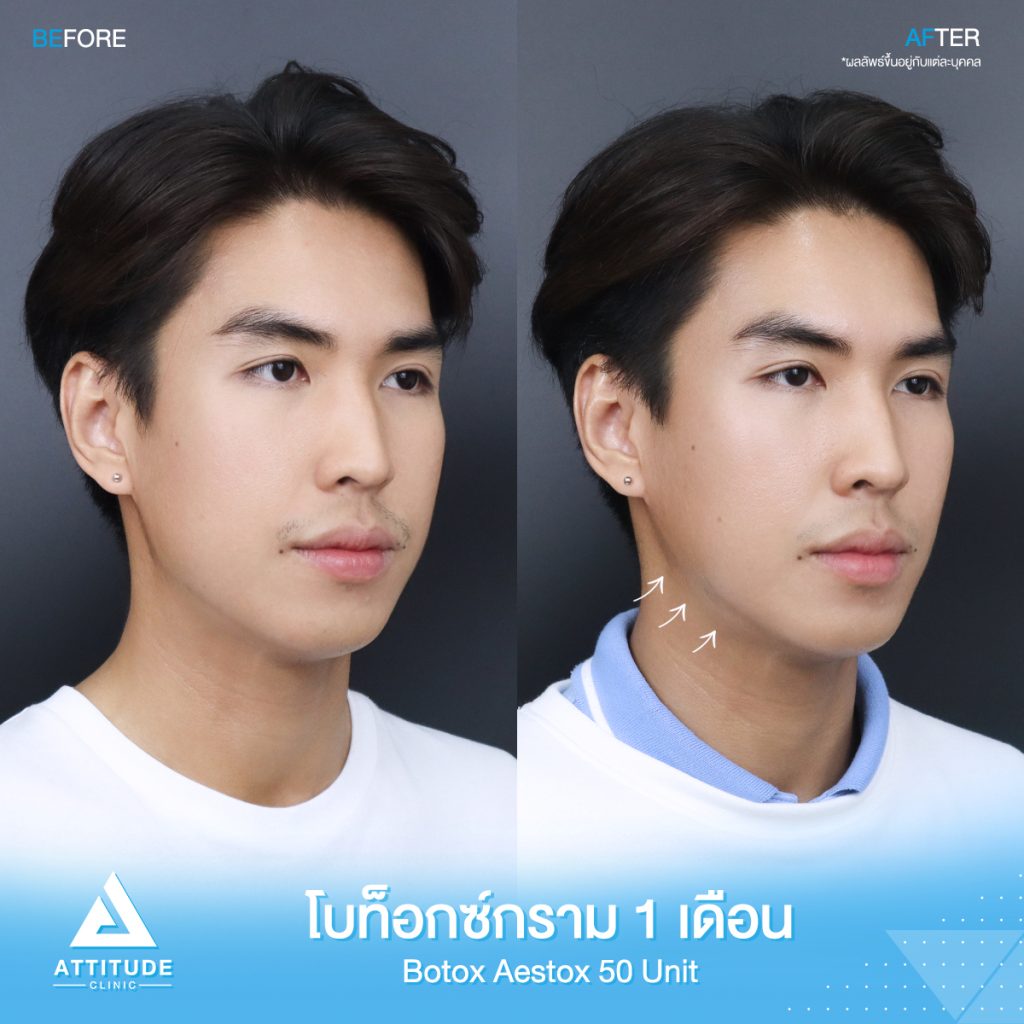 รีวิวฉีดโบท็อกซ์กราม จำนวน 50 ยูนิต ของน้องนนท์ อัปเดตหลังฉีด 1 เดือน ด้วยโบท็อกซ์ Aestox เกาหลี หน้าเรียวหล่อเป๊ะ โบท็อกซ์แท้ คุณภาพ มาตรฐาน อย. ไทยที่ Attitude Clinic