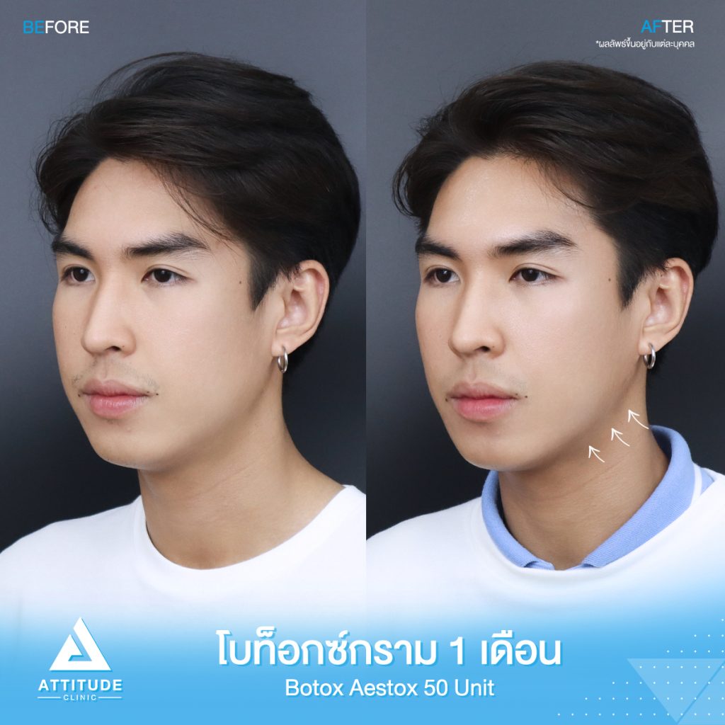 รีวิวฉีดโบท็อกซ์กราม จำนวน 50 ยูนิต ของน้องนนท์ อัปเดตหลังฉีด 1 เดือน ด้วยโบท็อกซ์ Aestox เกาหลี หน้าเรียวหล่อเป๊ะ โบท็อกซ์แท้ คุณภาพ มาตรฐาน อย. ไทยที่ Attitude Clinic