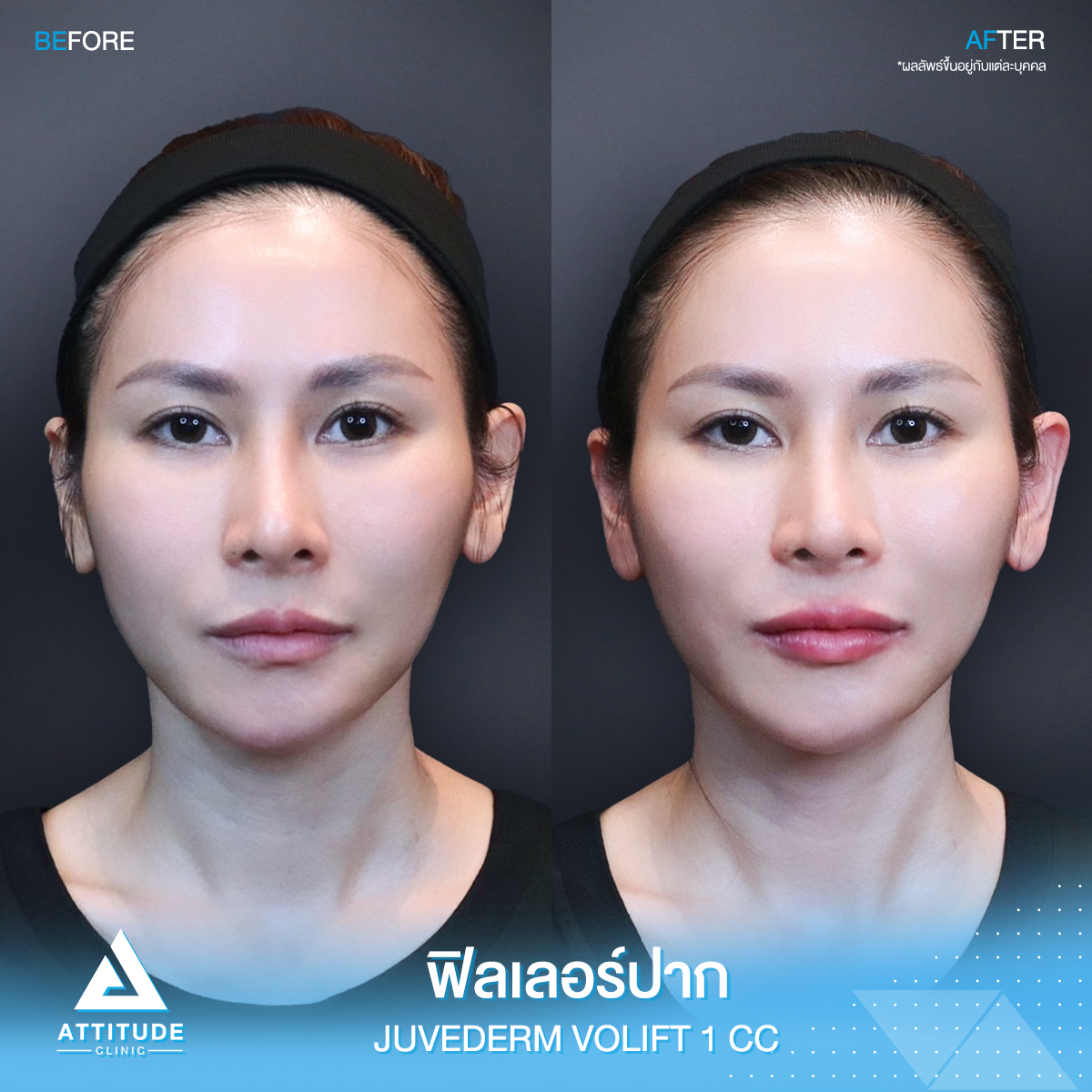 รีวิวฉีดฟิลเลอร์ปาก Juvederm Volift จำนวน 1cc เติมเต็มปากให้อวบอิ่ม สายฝอ น่าจุ๊บ ด้วยฟิลเลอร์แท้ คุณหมอเชี่ยวชาญ ต้องที่ ???????? ??????