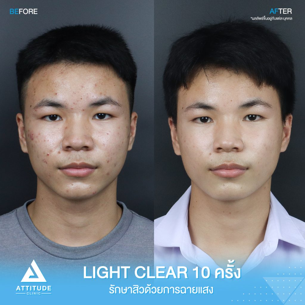 รีวิวรักษาสิวครบวงจร โปรแกรม Light Clear 7 ขั้นตอน จำนวน 10 ครั้ง ของน้องเอกพันธ์ ที่มีปัญหาสิวและรอยสิวจัดเต็ม หลังรักษาสิว ตอนนี้หน้าใสวิ้ง ผิวเรียบเนียน มั่นใจสุดๆ