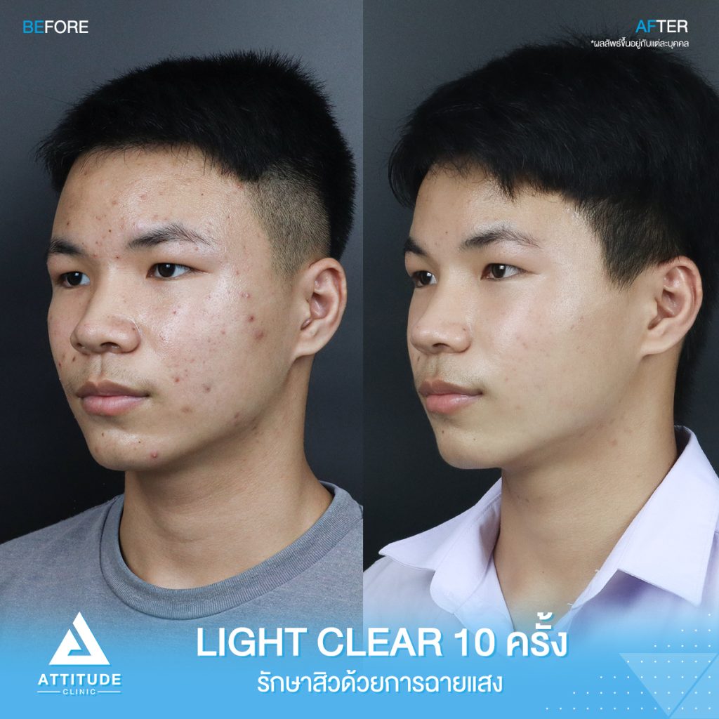 รีวิวรักษาสิวครบวงจร โปรแกรม Light Clear 7 ขั้นตอน จำนวน 10 ครั้ง ของน้องเอกพันธ์ ที่มีปัญหาสิวและรอยสิวจัดเต็ม หลังรักษาสิว ตอนนี้หน้าใสวิ้ง ผิวเรียบเนียน มั่นใจสุดๆ