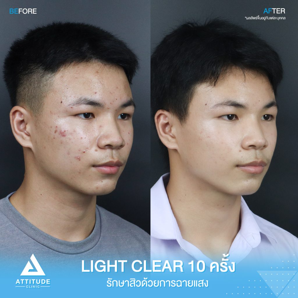 รีวิวรักษาสิวครบวงจร โปรแกรม Light Clear 7 ขั้นตอน จำนวน 10 ครั้ง ของน้องเอกพันธ์ ที่มีปัญหาสิวและรอยสิวจัดเต็ม หลังรักษาสิว ตอนนี้หน้าใสวิ้ง ผิวเรียบเนียน มั่นใจสุดๆ