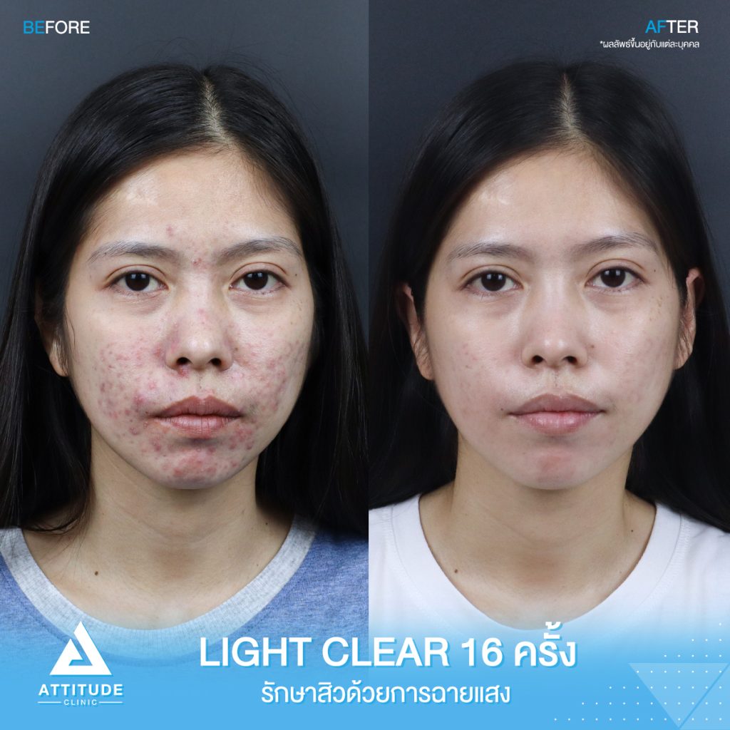 รีวิวรักษาสิวครบวงจร ผู้หญิง รีวิวรักษาสิวครบวงจร คุณกรกฎ โปรแกรม Light Clear 7 ขั้นตอน จำนวน 16 ครั้ง มีปัญหาสิวและรอยสิวจัดเต็ม หลังรักษาสิวตอนนี้หน้าใสวิ้ง ผิงเรียบเนียน มั่นใจสุดๆ