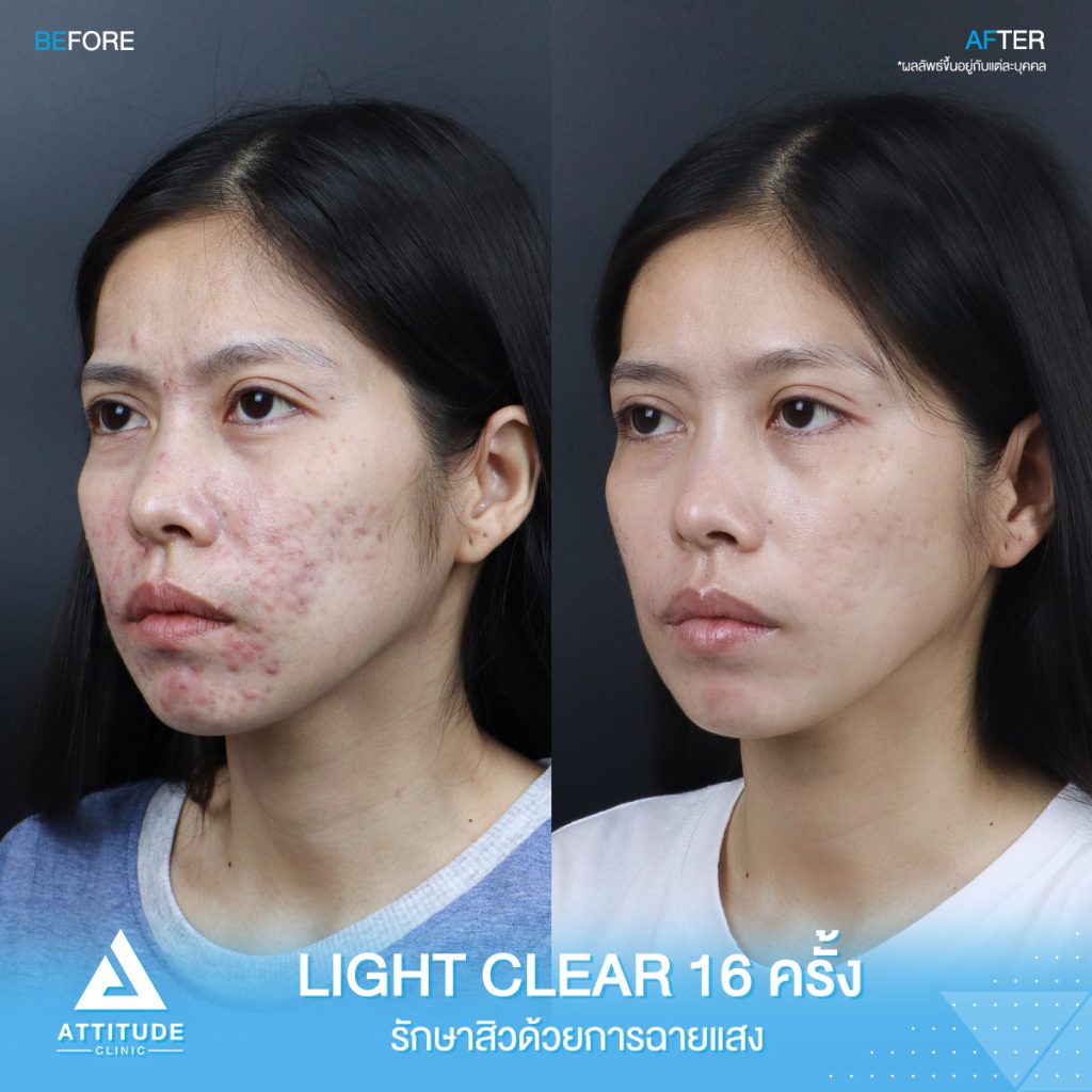 รีวิวรักษาสิวครบวงจร ผู้หญิง รีวิวรักษาสิวครบวงจร คุณกรกฎ โปรแกรม Light Clear 7 ขั้นตอน จำนวน 16 ครั้ง มีปัญหาสิวและรอยสิวจัดเต็ม หลังรักษาสิวตอนนี้หน้าใสวิ้ง ผิงเรียบเนียน มั่นใจสุดๆ